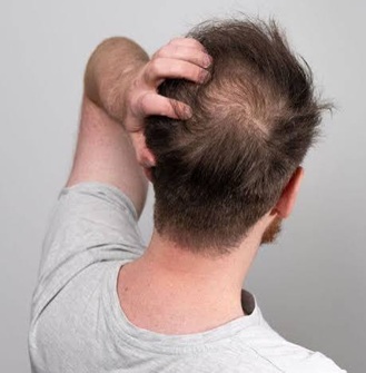 Tratamento para queda de cabelo e alopecia